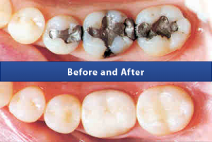 composite-and-fillings