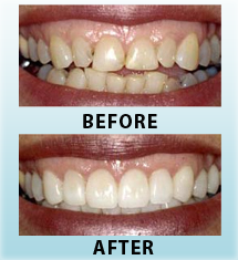 teeth-restoration